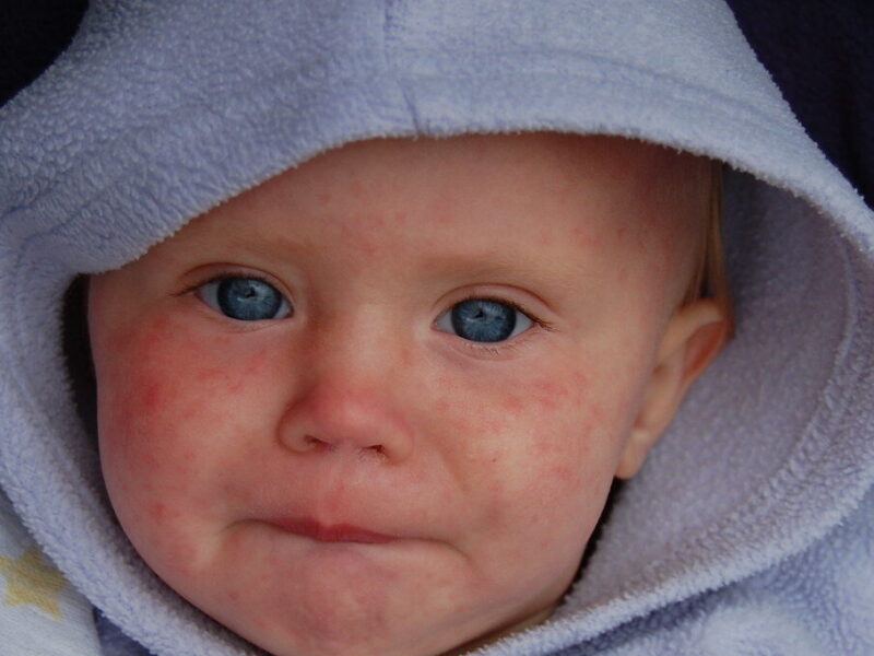 Measles Outbreak in Maryland: What we know